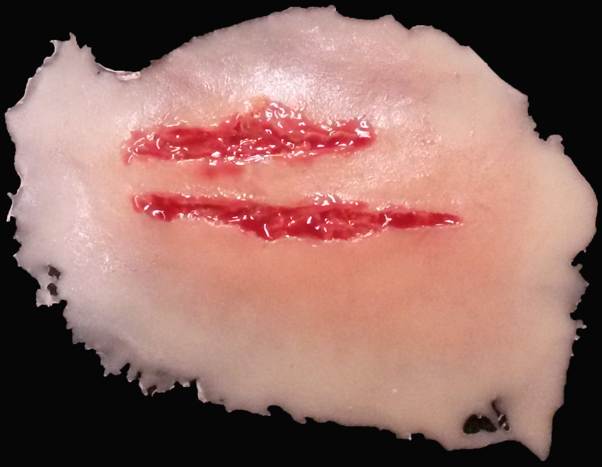 TW010 - Double Laceration